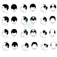 【SG亚洲胜游基因检测】过早<font color='red'>脱发</font>、掉发太多怎么办？你的方法可能是错的！